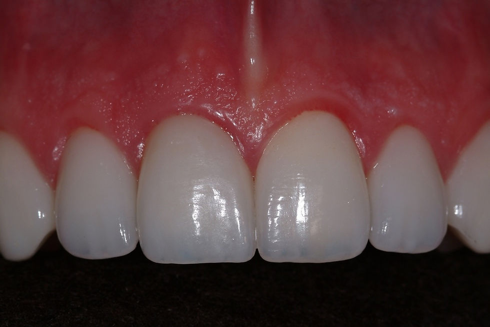 After Implant And Crowns