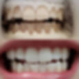 Teeth Whitening