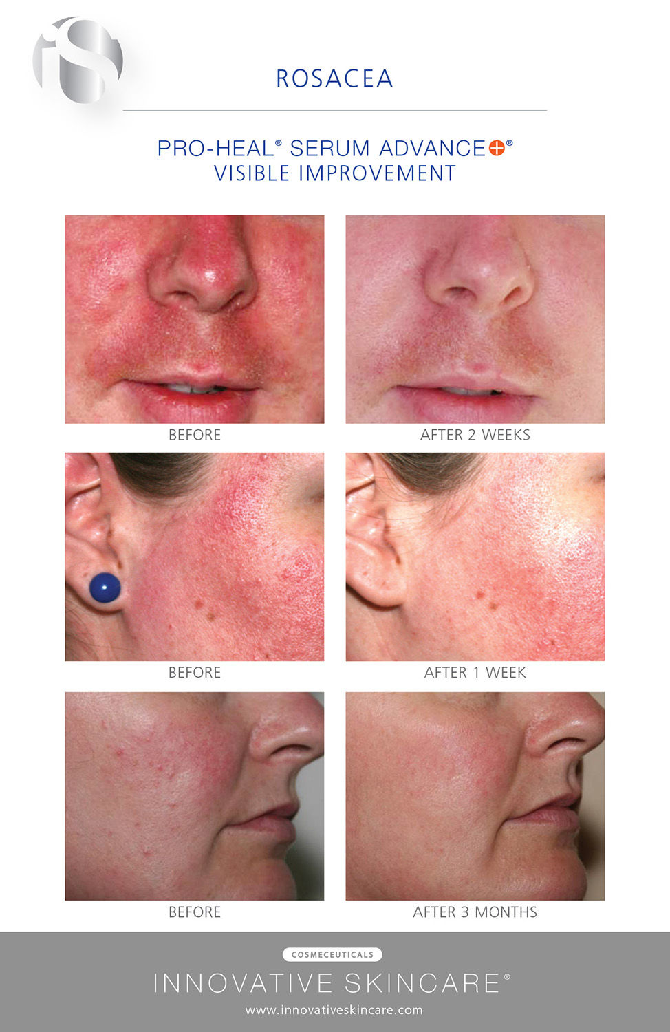 Thumbnail: iS CLINICAL Pro-Heel Serum Advance, 30ml