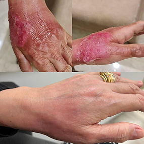 burn wound treatment