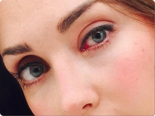 La conjuntivitis: generalmente es leve y fácil de tratar.