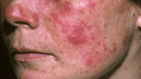 Investigadores revelan una causa genética del lupus.