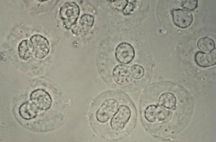 Imagen: Glóbulos blancos en la orina de un paciente con bacteriuria y piuria, una infección del tracto urinario. Las células tienen núcleos lobulados y gránulos citoplásmicos refráctiles (Fotografía cortesía de la Facultad de Medicina de la Universidad de Utah).