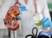 Otra razón fundamental para prevenir y controlar la diabetes: Es una de las principales causas de enfermedad renal crónica