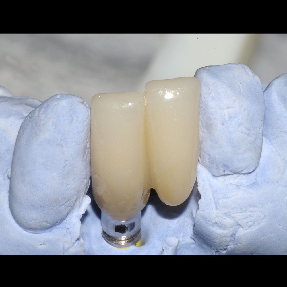 High Trans Zirconia on a Custom Abutment