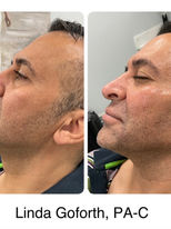 Image of a before and after of Dermal Filler