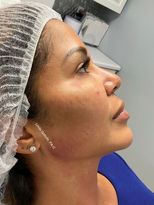 Image of a before and after of Dermal Filler