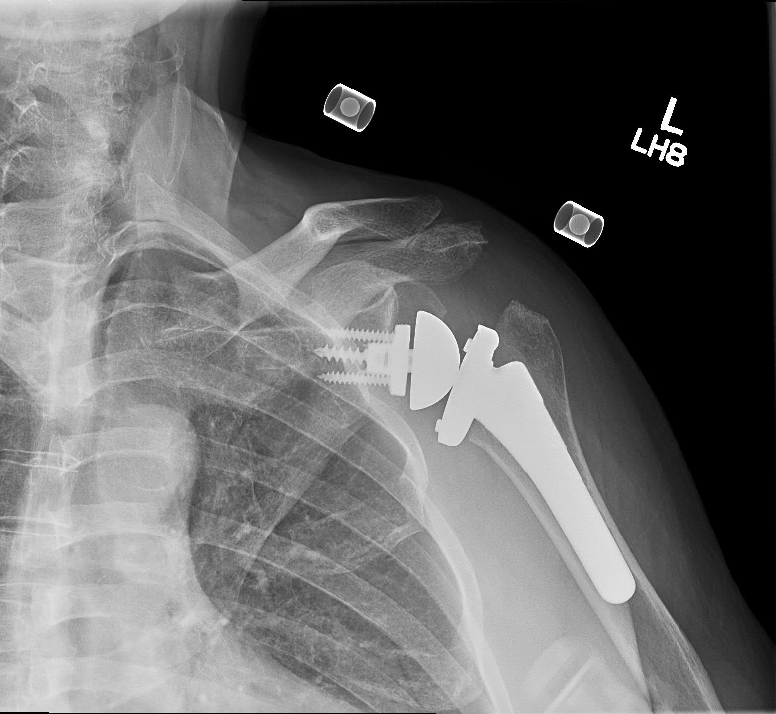 shoulder superior capsular reconstruction shoulder superior capsular reconstruction