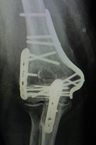 DistalHumerus.jpeg