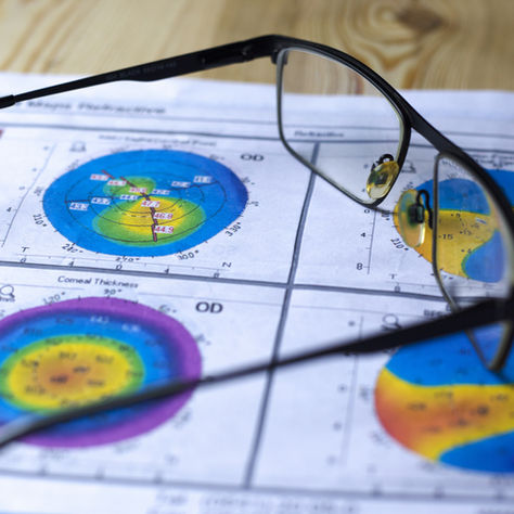 Il cheratocono: quando la cornea si deforma