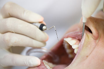 Screening for gum disease at Evergreen Dental Group in Kirkland, WA