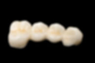 Dental bridges at Evergreen Dental Group in Kirkland, WA