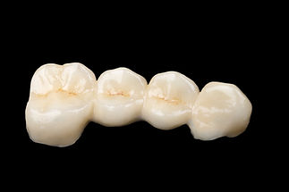 Dental bridges at Evergreen Dental Group in Kirkland, WA