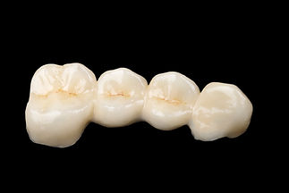 Dental bridges at Evergreen Dental Group in Kirkland, WA