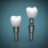 Comprehensive implant therapy at Evergreen Dental Group in Kirkland, WA