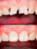Dental Bonding at Evergreen Dental Group in Kirkland, WA
