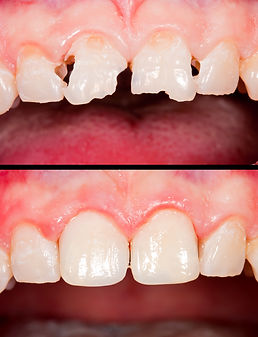 Dental Bonding at Evergreen Dental Group in Kirkland, WA