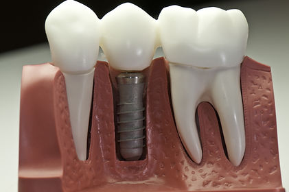 Dental Implants at Evergreen Dental Group in Kirkland, WA