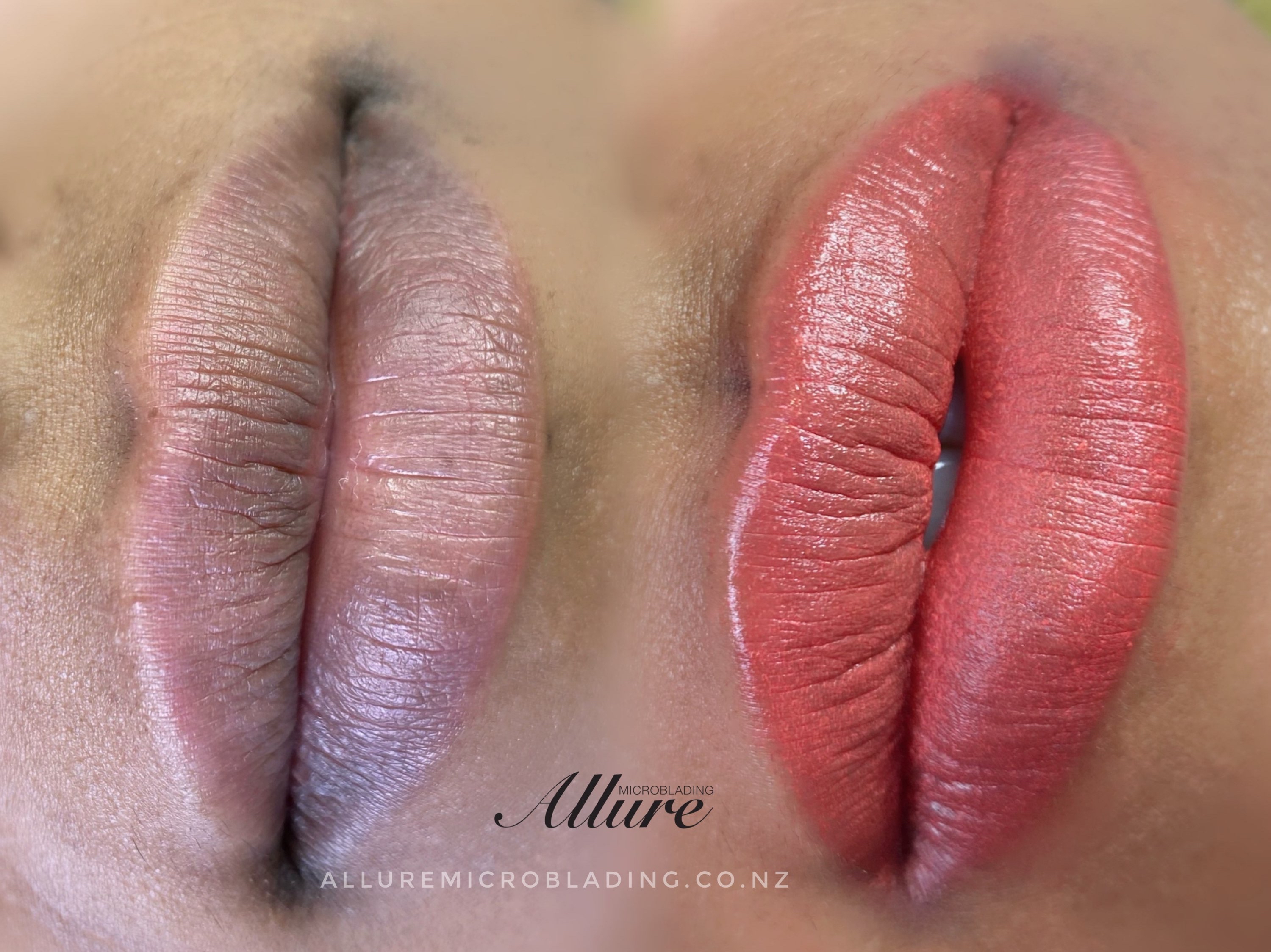 Lip Neutralisation before and after