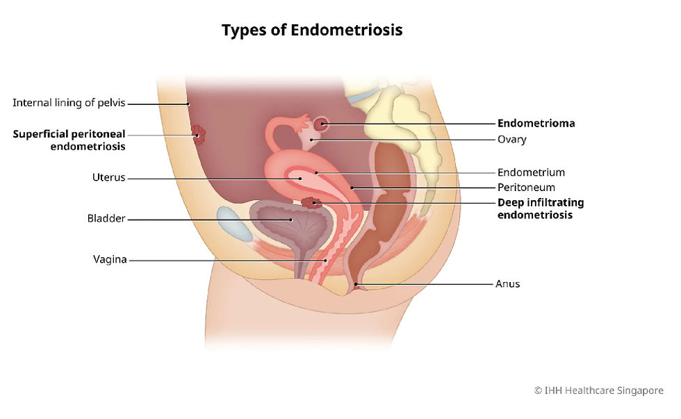Types of Endometriosis image