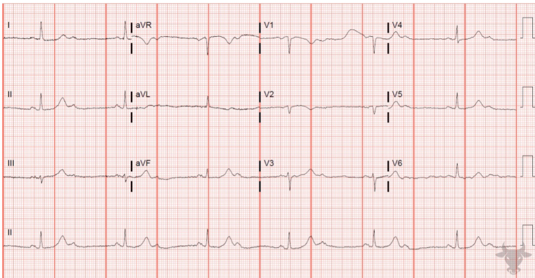 Lesson 6: Bradycardia