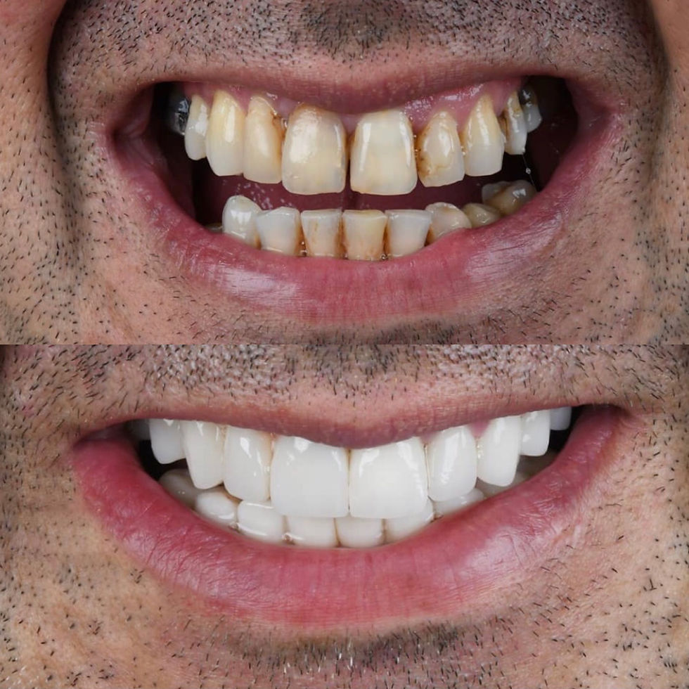 Smilemakeover , Crowns, veneers, Hollywood Smile