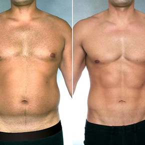 Six-Pack Liposuction.jpg