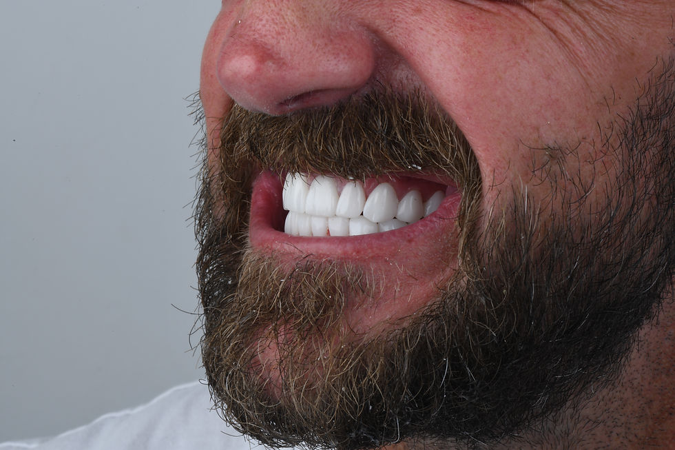 Smilemakeover , Crowns, veneers, Hollywood Smile