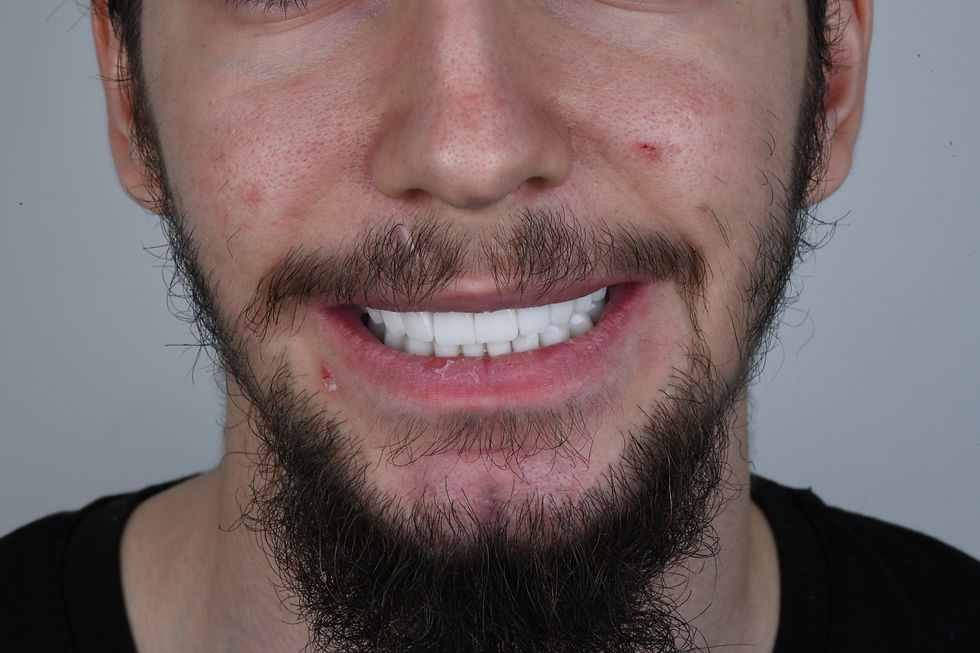 Smilemakeover , Crowns, veneers, Hollywood Smile