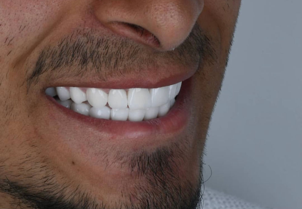 Smilemakeover , Crowns, veneers, Hollywood Smile
