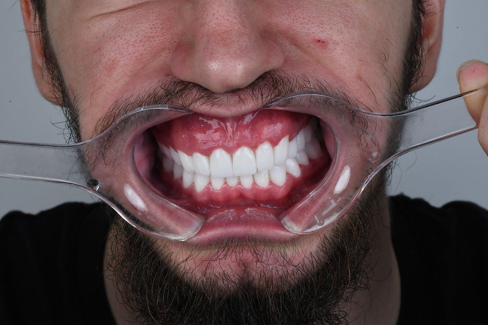 Smilemakeover , Crowns, veneers, Hollywood Smile