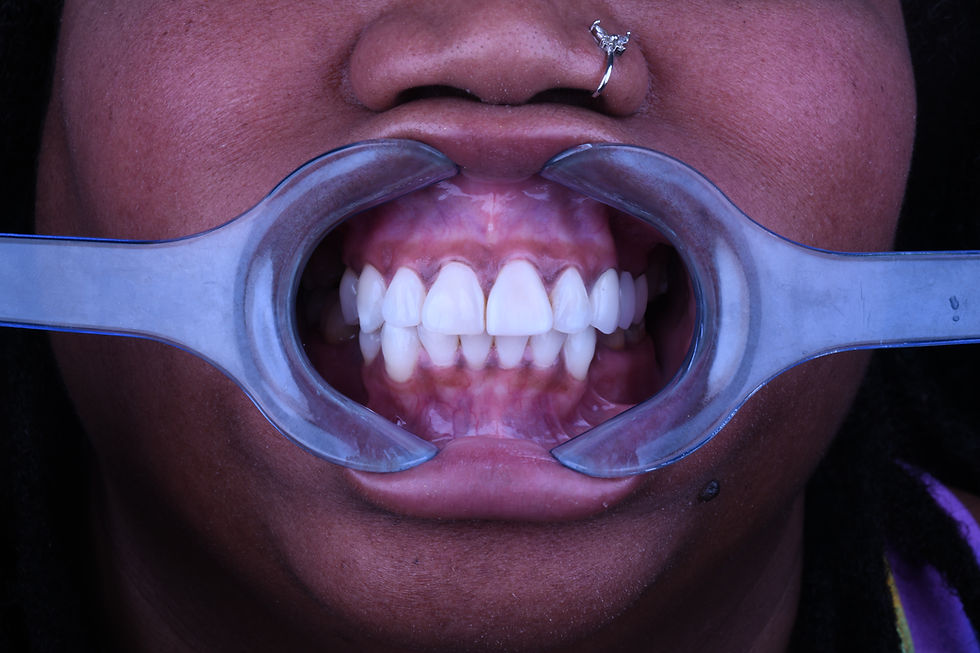 Smilemakeover , Crowns, veneers, Hollywood Smile