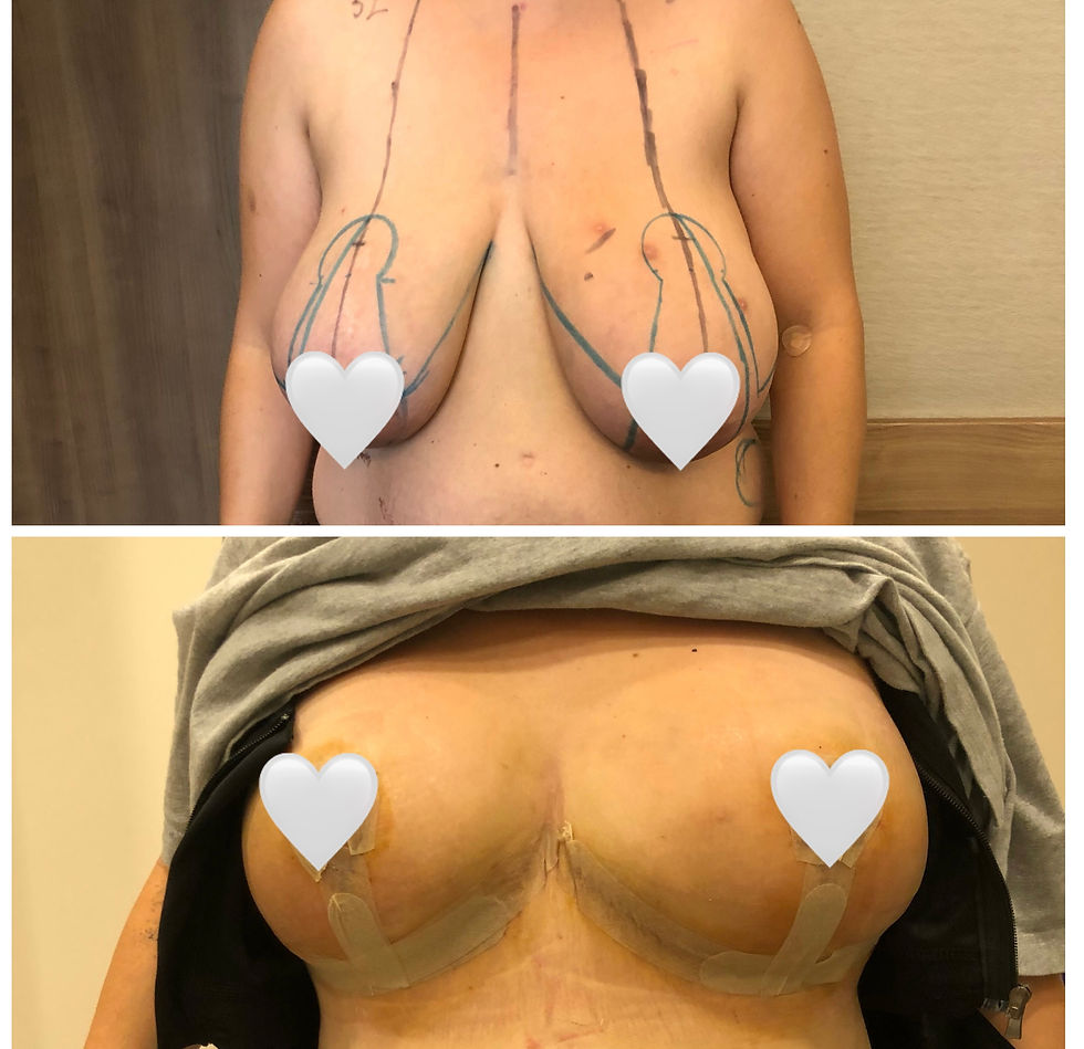 Brust op , Breatssurgery, Breastlift, Breastaugmentation, Brustvergrößerung