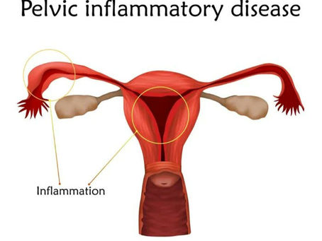 🌿 How I Healed My Pelvic Infection Naturally – No More White Discharge or Pain