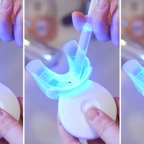 Que faut-il penser des kits de blanchiment dentaire ?
