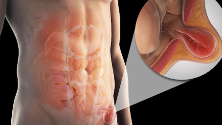 DIAGNOSTICUL CLINIC AL HERNIEI INGHINALE