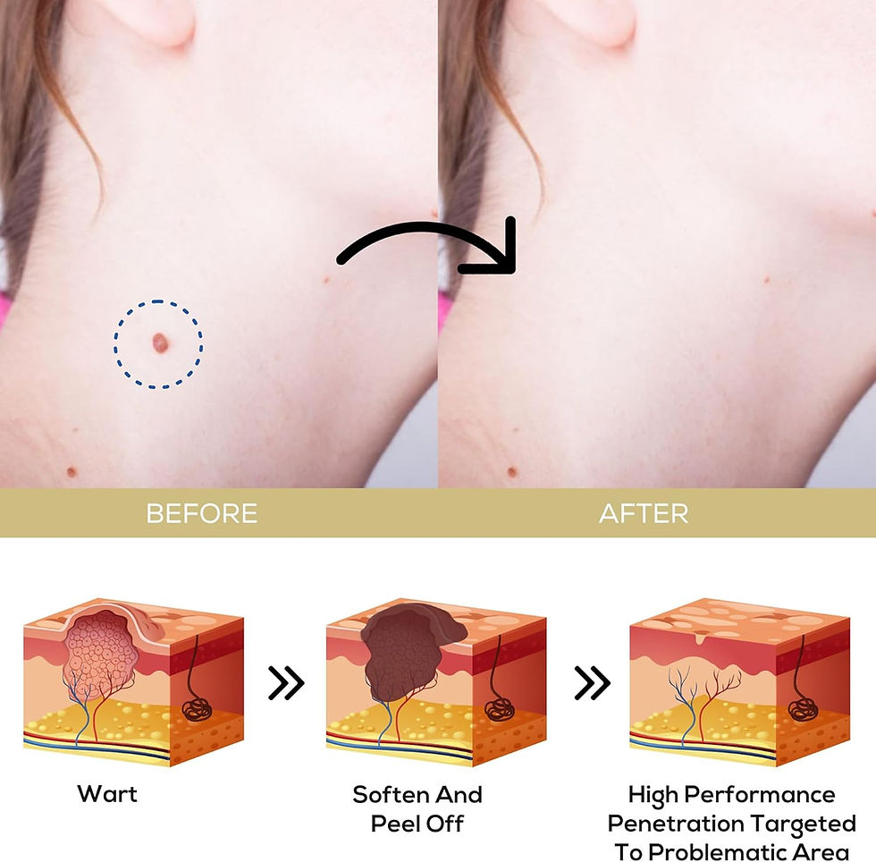 Thumbnail: Fast-Acting Wart Remover Cream: Salicylic Acid Wart Remover for Men Women