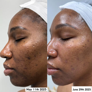 Before and after acne and dark spot transformation after 8 customized treatments using chemical peels and Green Peel.