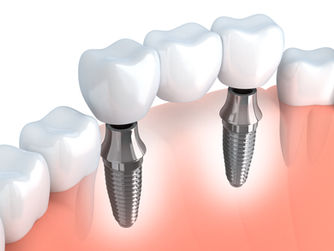 Manteniment d'implants dentals
