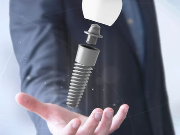 Implantes Dentales en Sant Cugat del Vallés - Pallejà