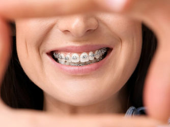 Limpieza Dental Profesional: La base de la Odontología Preventiva