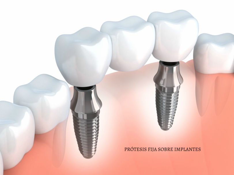 Implantes dentales con fundas