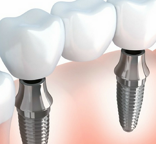 implant de titani, l'ajust perfecte per a les peces dentals