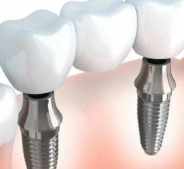 implant de titani, l'ajust perfecte per a les peces dentals