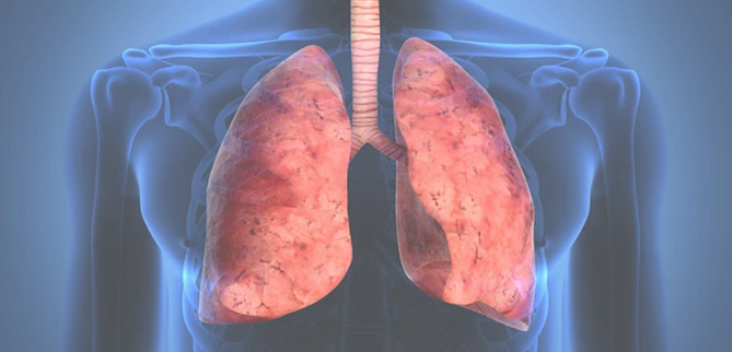 Fibrosis Pulmonar - Cieri