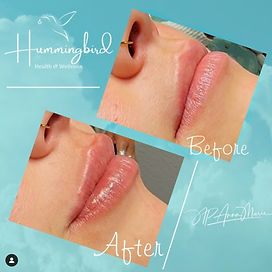 Lip Fillers in Monument & Colorado Springs