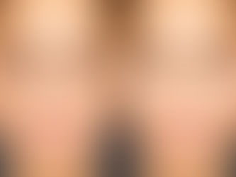 Achieve a Youthful Look with the Best Eyelid Surgery Doctor in Riyadh