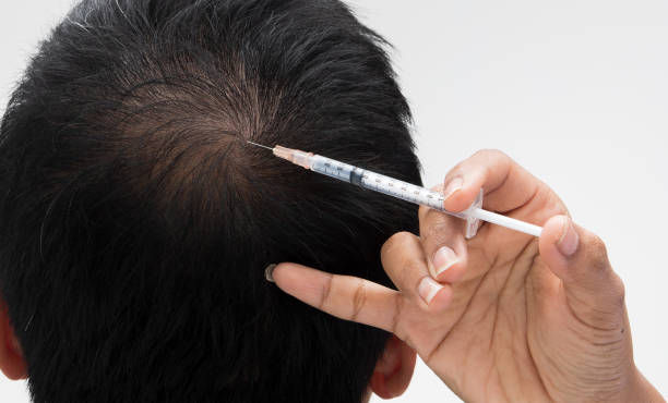 Regain Your Crown: PRP Hair Treatment Unveiled in Riyadh