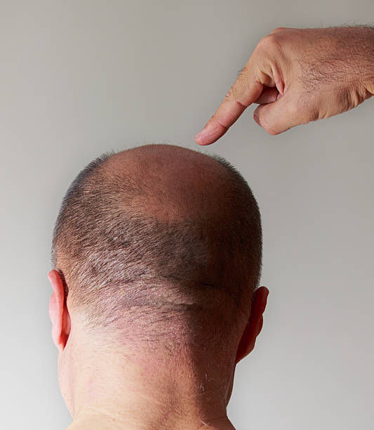 Decoding the Expenses: Understanding Hair Transplant Costs in Riyadh