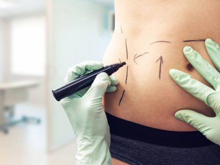 Trim and Toned: Abdominal Liposuction in Riyadh